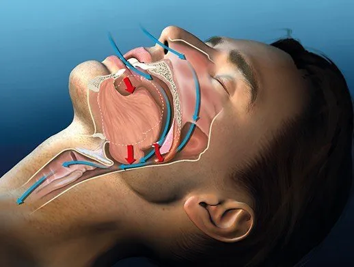 Illustration of a sleeping man with the airway collapsing at the back of the throat
